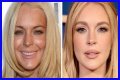 Celebrity Plastic Surgery News - Us Weekly
